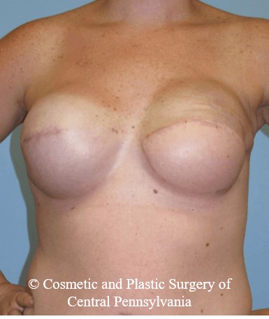 Breast Reconstruction After