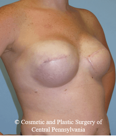 Breast Reconstruction After