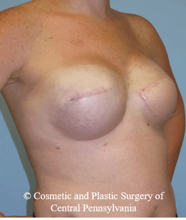 Breast Reconstruction After