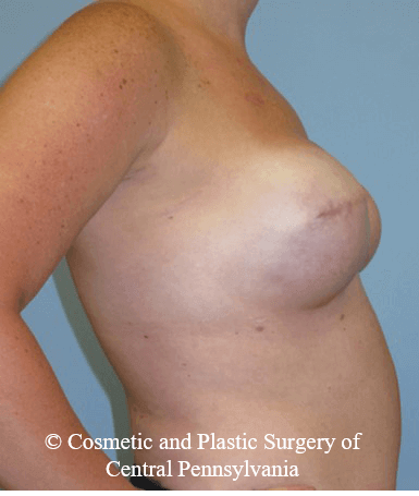 Breast Reconstruction After