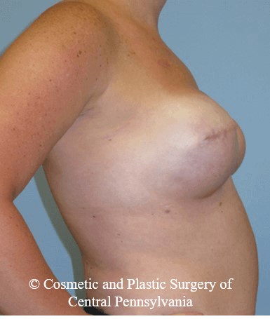 Breast Reconstruction After