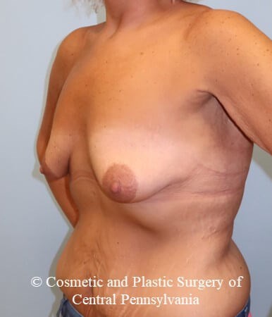 Breast Augmentation Lift Before