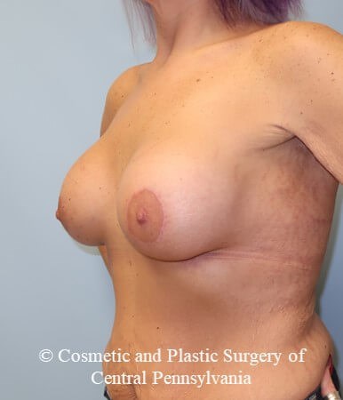 Breast Augmentation Lift After