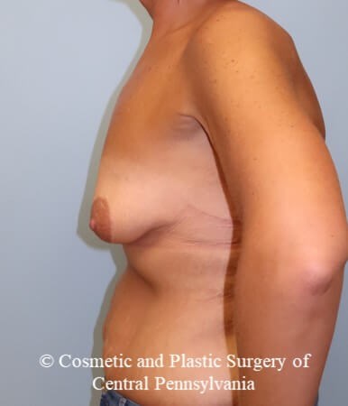 Breast Augmentation Lift Before