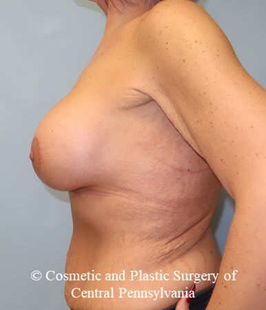 Breast Augmentation Lift After
