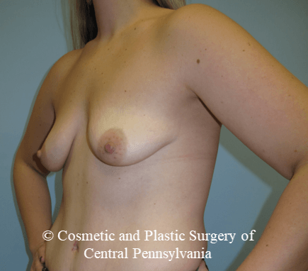 Breast Fat Grafting Before