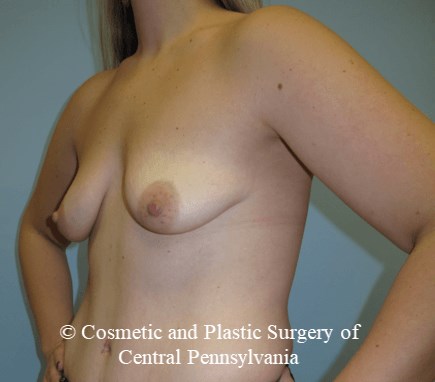 Breast Fat Grafting Before