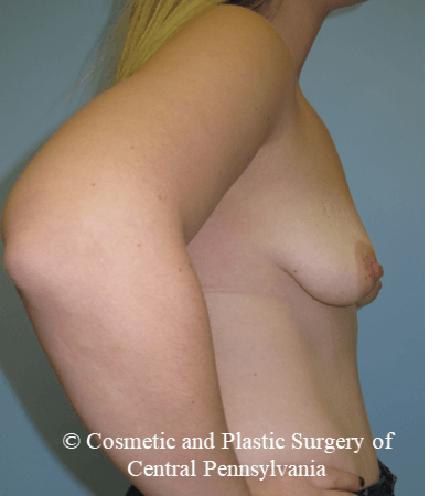 Breast Fat Grafting Before