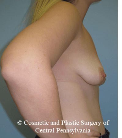 Breast Fat Grafting Before