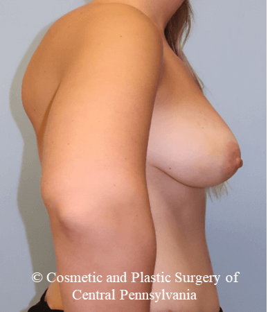 Breast Fat Grafting After
