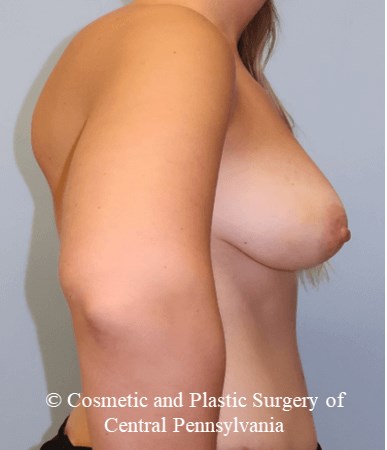 Breast Fat Grafting After