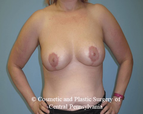 Breast Reduction After