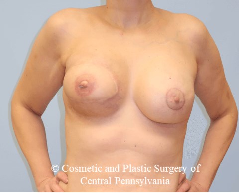 Breast Reconstruction After