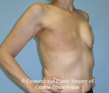 Breast Reconstruction Before