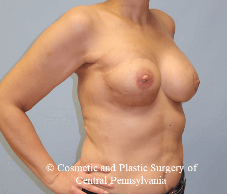 Breast Reconstruction After