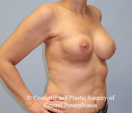 Breast Reconstruction After