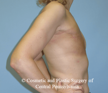 Breast Reconstruction Before