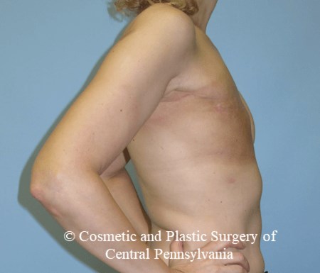 Breast Reconstruction Before