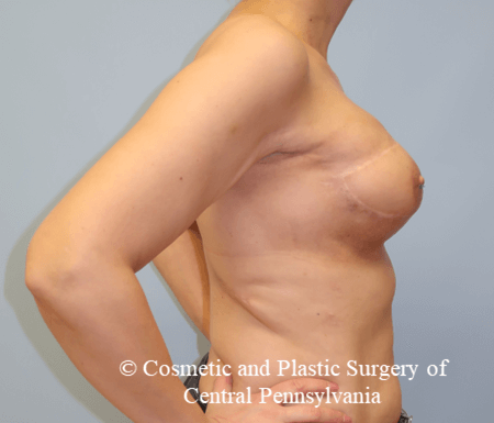 Breast Reconstruction After