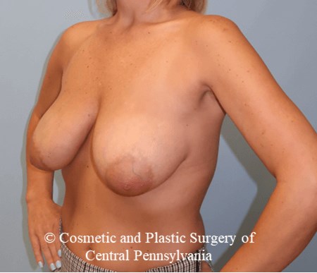 Breast Reduction Before