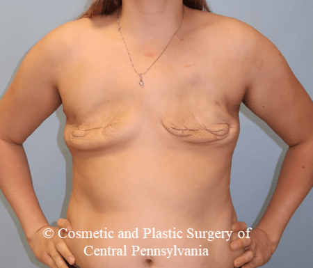 Breast Reconstruction Before