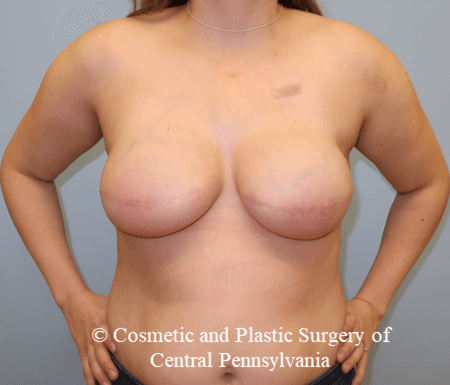 Breast Reconstruction After