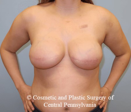 Breast Reconstruction After