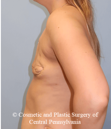 Breast Reconstruction Before
