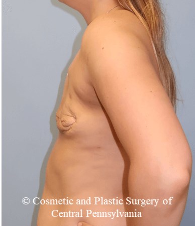 Breast Reconstruction Before