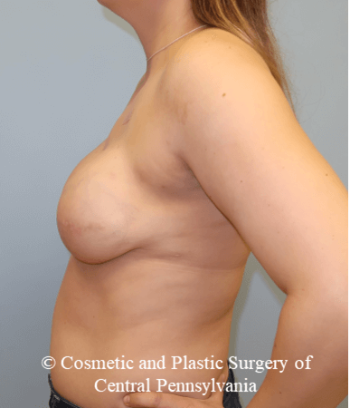Breast Reconstruction After