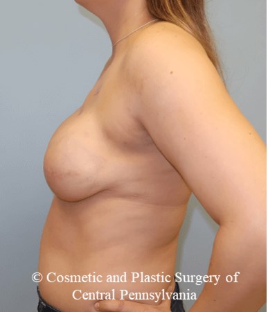 Breast Reconstruction After