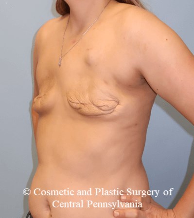 Breast Reconstruction Before