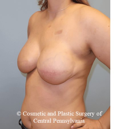 Breast Reconstruction After