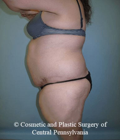Body Lift After