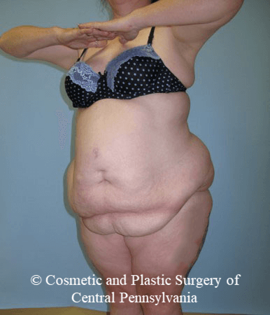 Body Lift Before