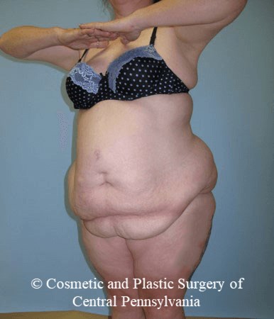 Body Lift Before
