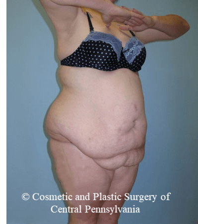 Body Lift Before