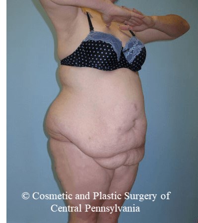 Body Lift Before