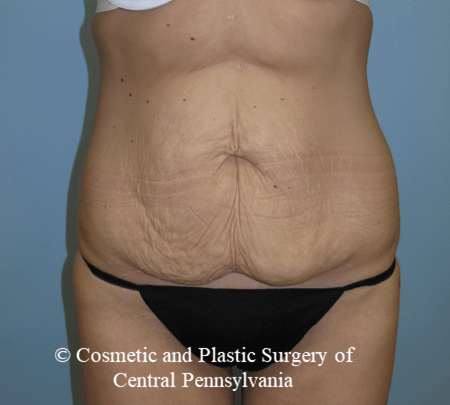 Tummy Tuck Before