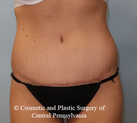 Tummy Tuck After