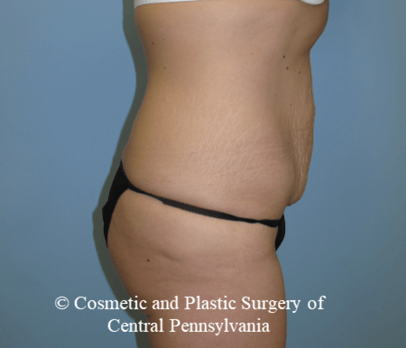 Tummy Tuck Before