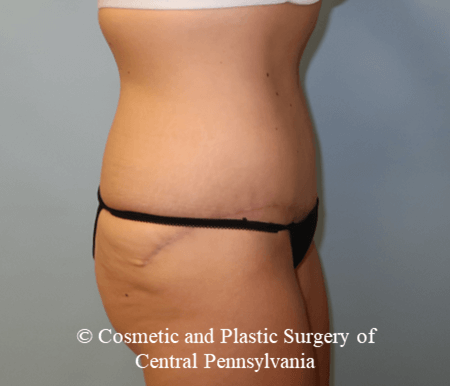 Tummy Tuck After