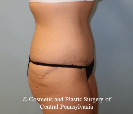 Tummy Tuck After