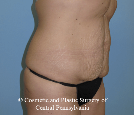 Tummy Tuck Before