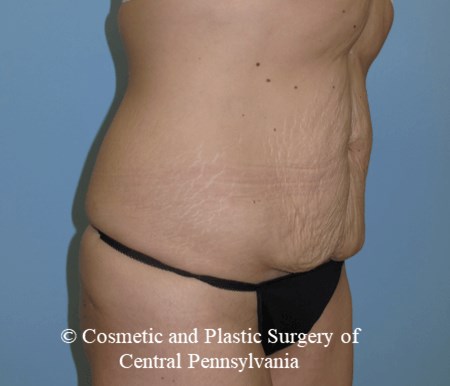 Tummy Tuck Before