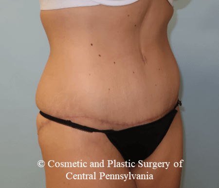 Tummy Tuck After