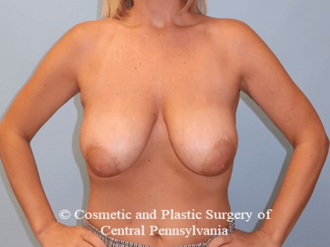 Breast Reduction Before