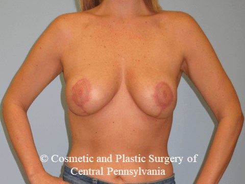 Breast Reduction After