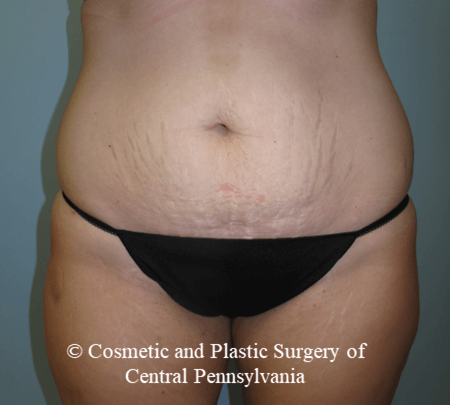 Abdominoplasty Before