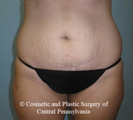 Abdominoplasty Before
